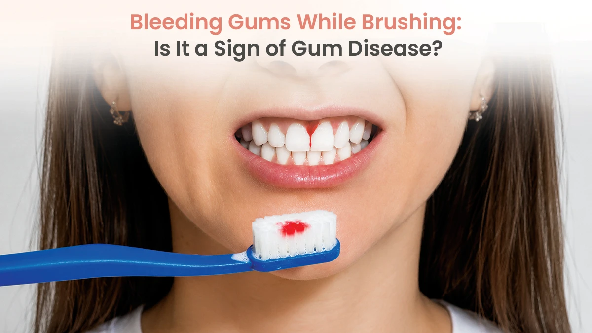 Bleeding Gums While Brushing: Is It a Sign of Gum Disease?